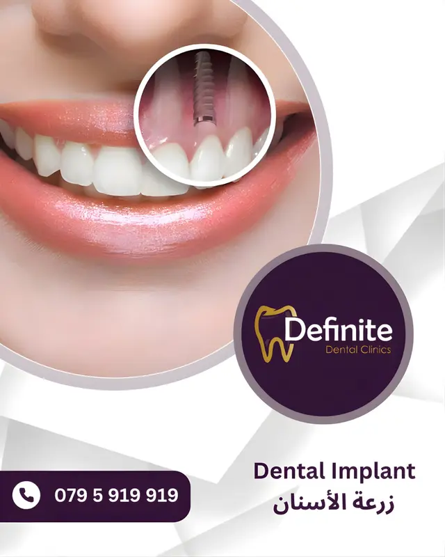 Implants
