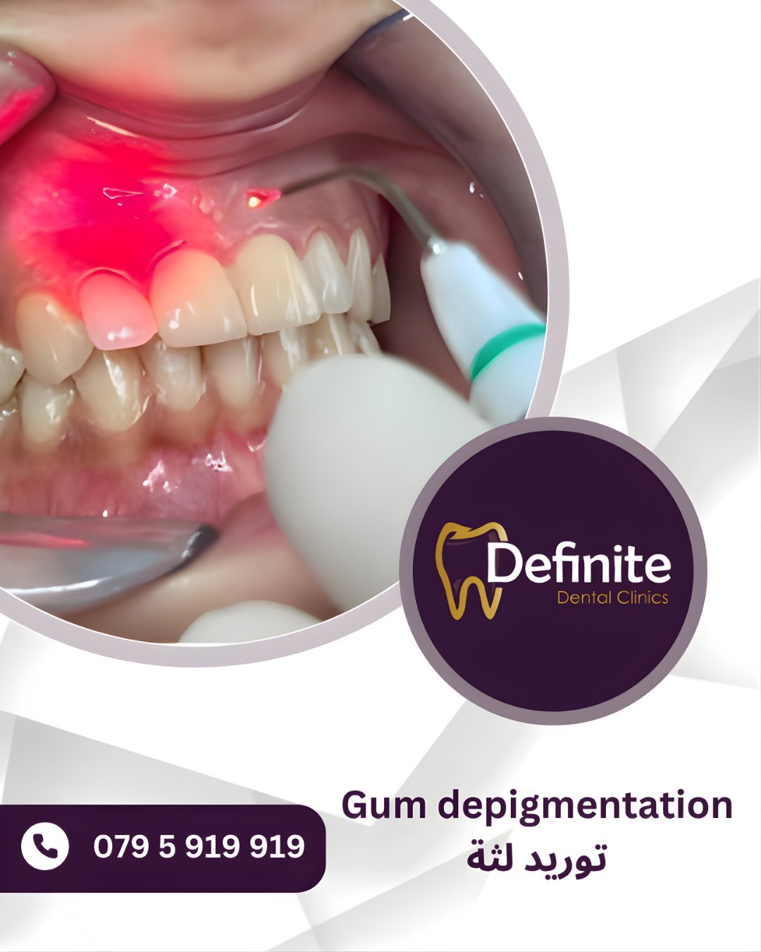 Gum Depigmentation