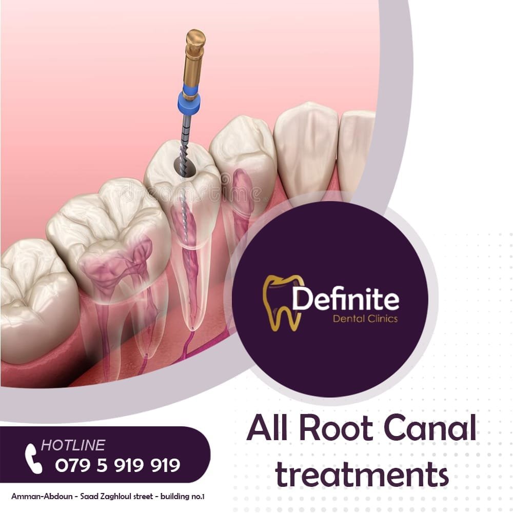Root Canal Treatment