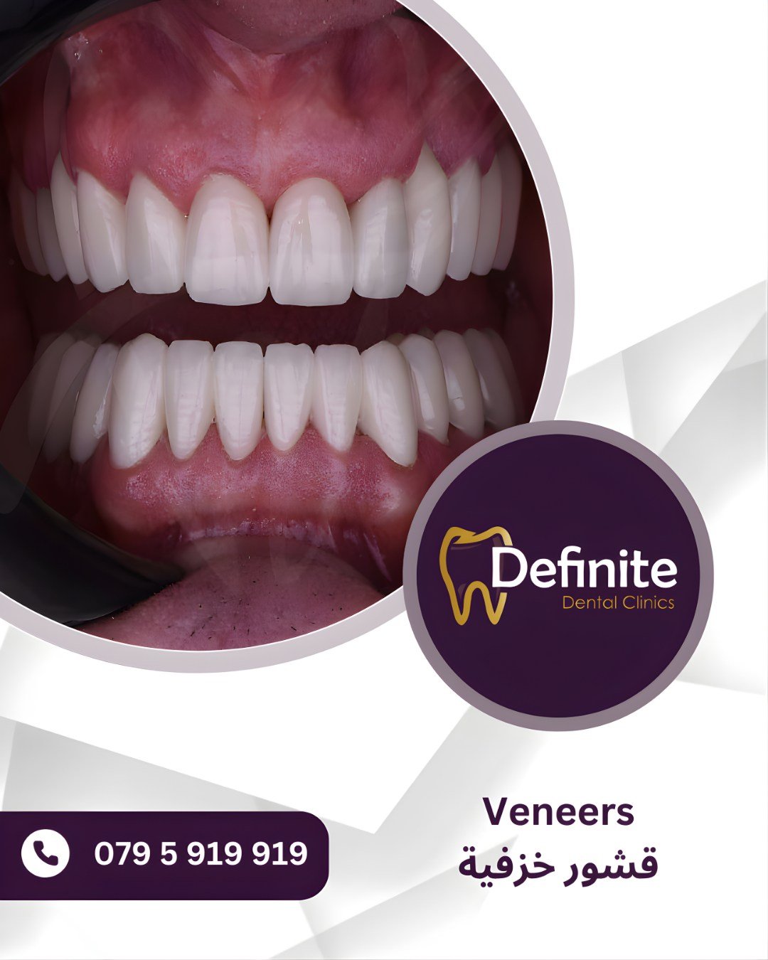 Veneers